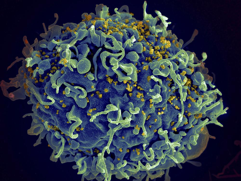 This colorized electron microscope image made available by the U.S. National Institutes of Health shows a human T cell, indicated in blue, under attack by HIV, in yellow, the virus that causes AIDS.