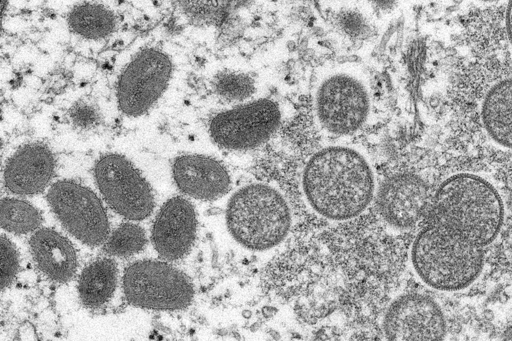 This 2003 electron microscope image made available by the Centers for Disease Control and Prevention shows mature, oval-shaped monkeypox virions, left, and spherical immature virions, right.