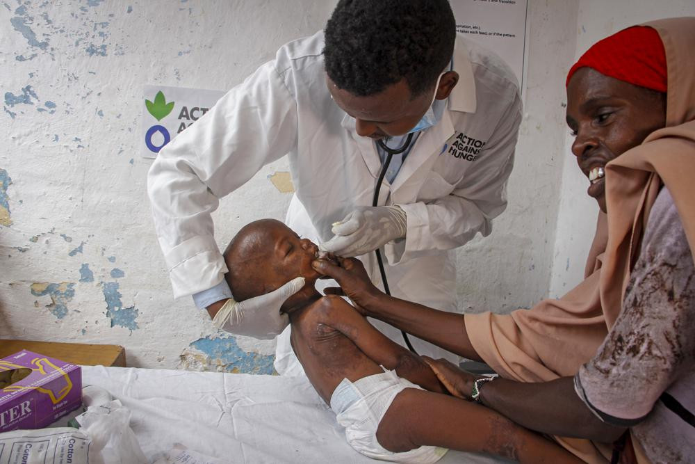 Doctor Mustaf Yusuf treats Ali Osman, 3, who is showing symptoms of Kwashiorkor as his mother Owliyo Hassan Salaad, 40, holds him at a malnutrition stabilization in Mogadishu, Somalia Sunday, June 5, 2022.