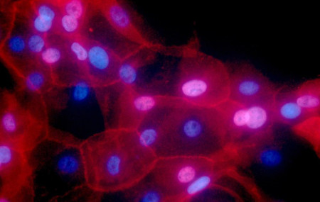 FILE - This undated fluorescence-colored microscope image made available by the National Institutes of Health in September 2016 shows a culture of human breast cancer cells.