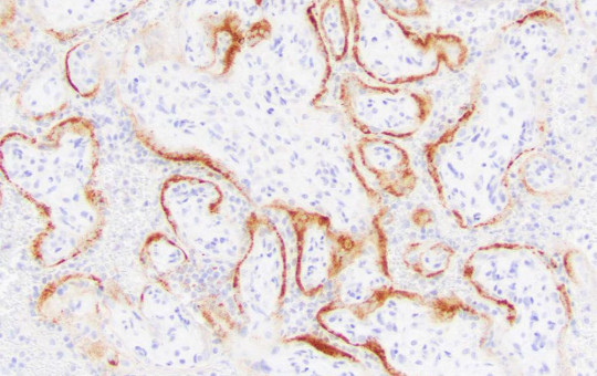 This microscope image provided by the College of American Pathologists and Archives of Pathology and Laboratory Medicine shows placental cells from a stillbirth with SARS-CoV-2 infection indicated by the darker stains.
