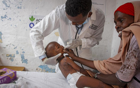 Doctor Mustaf Yusuf treats Ali Osman, 3, who is showing symptoms of Kwashiorkor as his mother Owliyo Hassan Salaad, 40, holds him at a malnutrition stabilization in Mogadishu, Somalia Sunday, June 5, 2022.