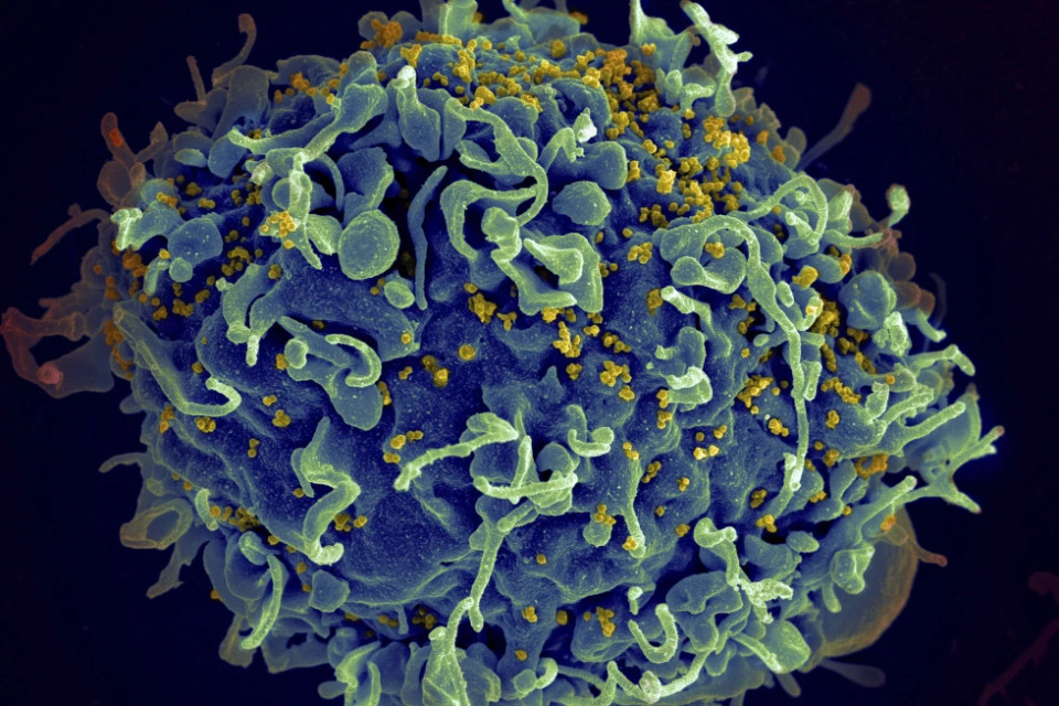 FILE - This electron microscope image made available by the U.S. National Institutes of Health shows a human T cell, in blue, under attack by HIV, in yellow, the virus that causes AIDS.  AP/RSS Photo