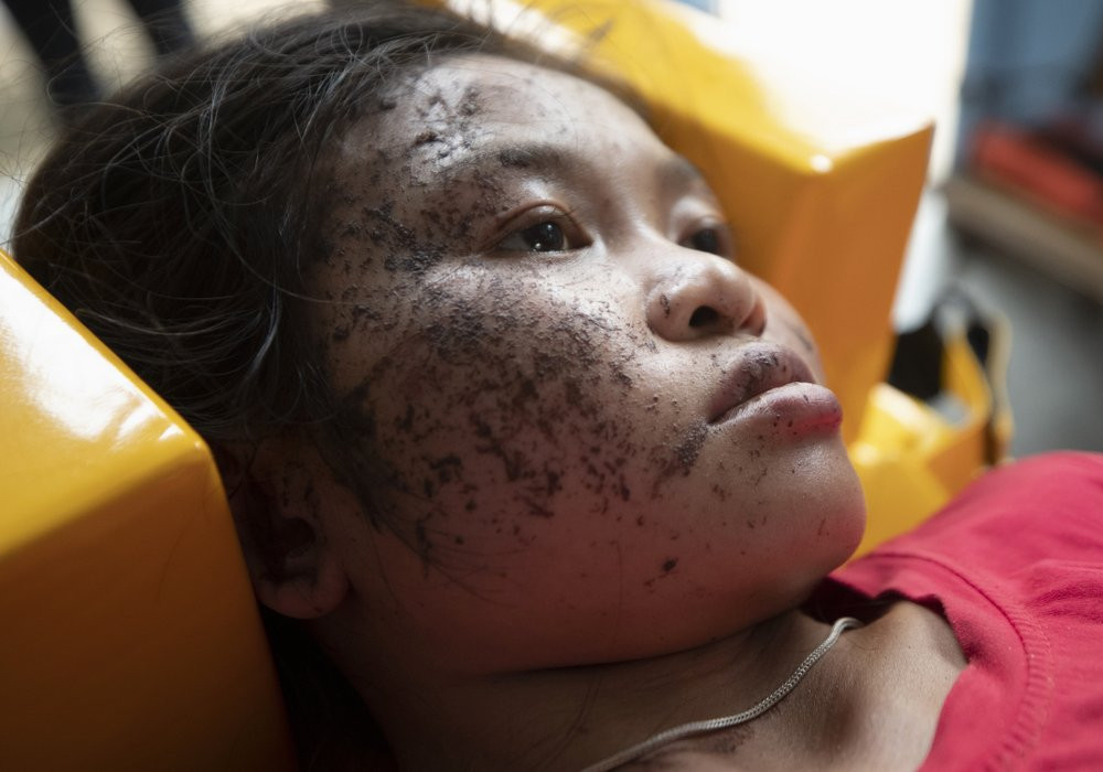 An injured ethnic Karen villager from Myanmar rests as she is treated after crossing the Salawin river via boat at Ban Mae Sam Laep Health Center, Mae Hong Son province, Thailand on Tuesday M