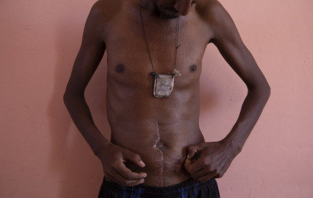 Farmer Nega Chekole, 30, a Tigrayan refugee from Humera, touches his stitched wound in Hamdayet, eastern Sudan, near the border with Ethiopia, on March 14, 2021.