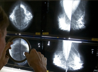 FILE - A radiologist uses a magnifying glass to check mammograms for breast cancer in Los Angeles, May 6, 2010.  AP/RSS Photo
