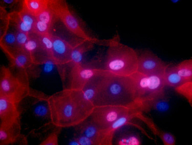 Researchers are trying to unlock the secrets of senescent cancer cells which can cause the disease to come back. Flickr
