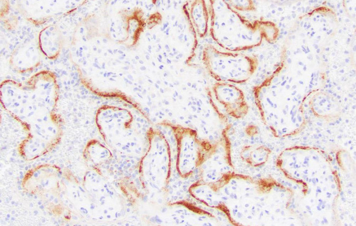 This microscope image provided by the College of American Pathologists and Archives of Pathology and Laboratory Medicine shows placental cells from a stillbirth with SARS-CoV-2 infection indi