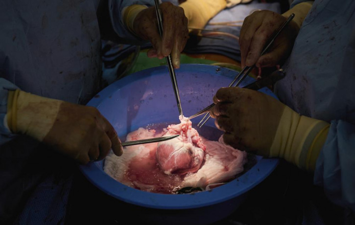 In this photo provided by NYU Langone Health, surgeons prepare a genetically modified pig heart for transplant into a recently deceased donor at NYU Langone Health on July 6, 2022, in New Yor