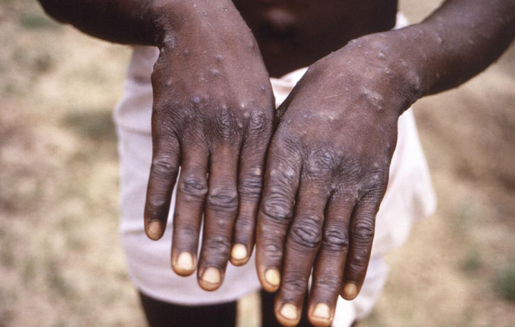 FILE - This 1997 image provided by the CDC during an investigation into an outbreak of monkeypox in the Democratic Republic of the Congo (DRC), formerly Zaire, and depicts the dorsal surfaces