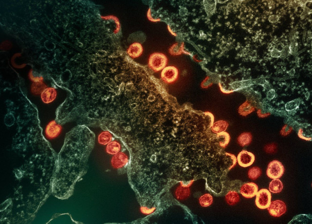 HIV virus particles (red/gold) budding and replicating from a chronically infected H9 cell (green). HIV virus particles (red/gold) budding and replicating from a chronically infected H9 cell (green). Flickr: NIAID