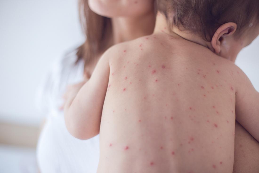 Measles outbreak in Rajpur