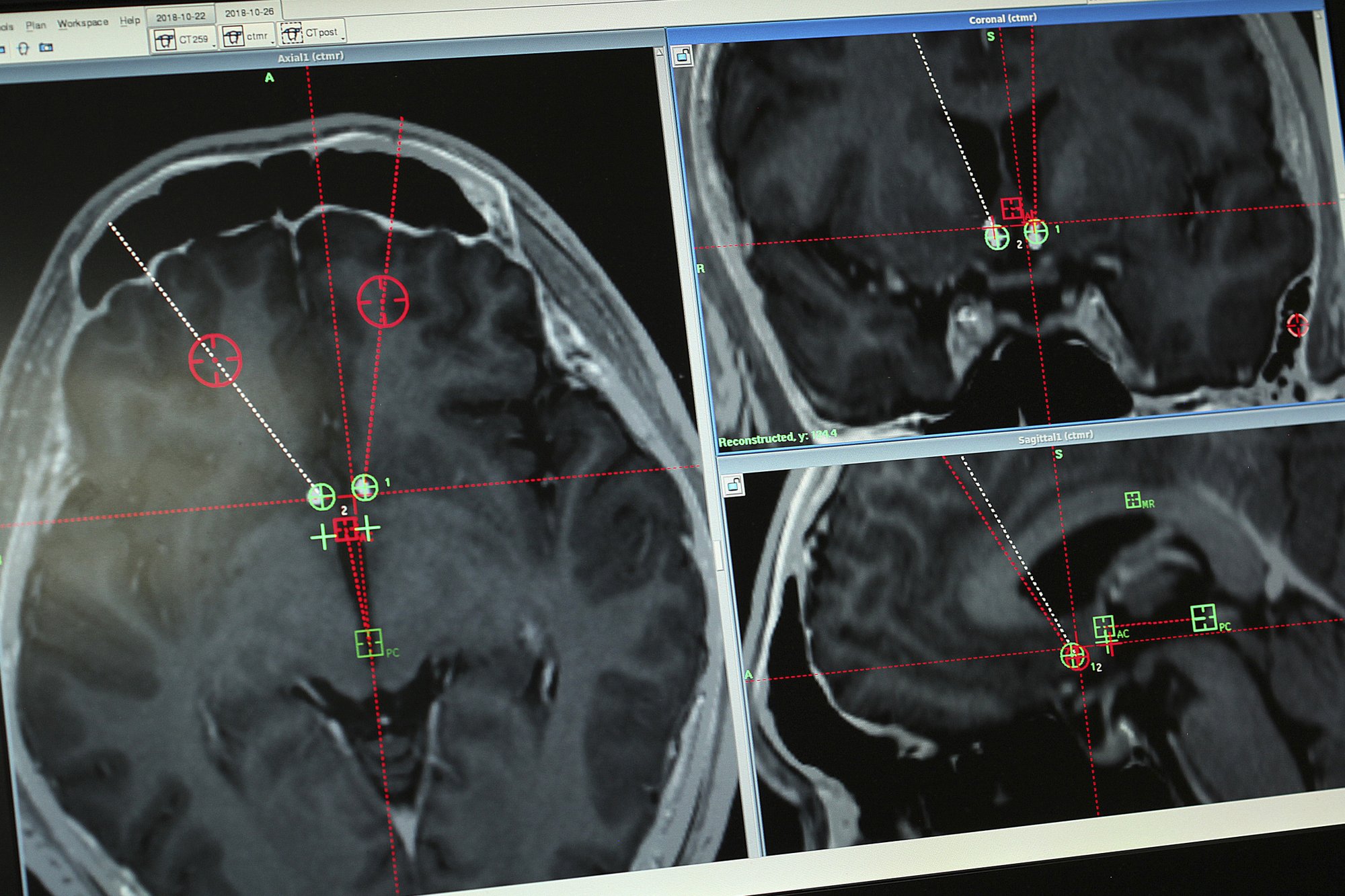 Chinese researchers try brain implants to treat drug addicts